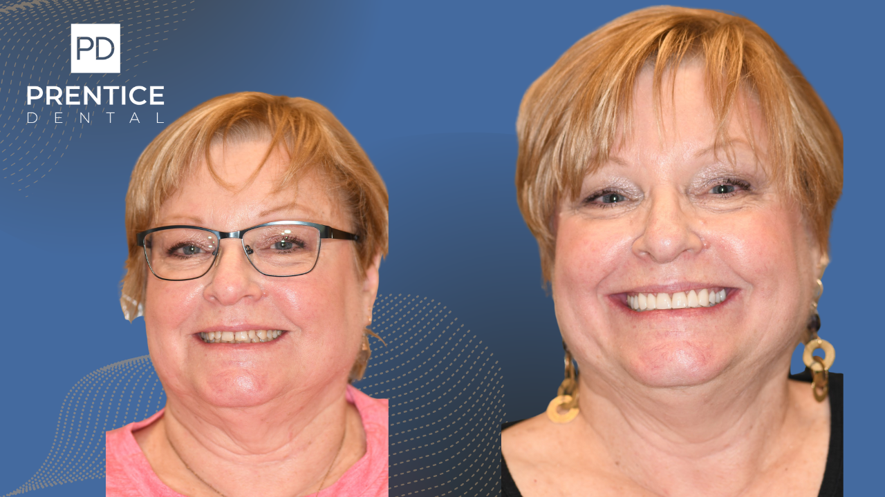 Comprehensive dental restoration before after full-mouth treatment Flower Mound TX
