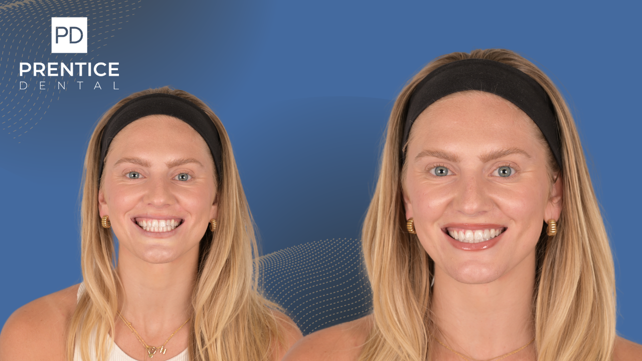 Natural smile restoration mature female patient before after Flower Mound TX
