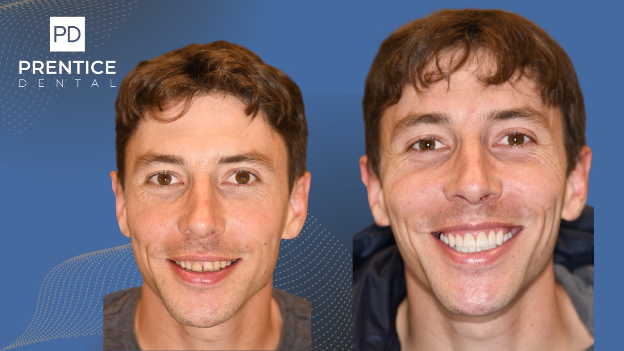 Complete smile rehabilitation senior female before after Prentice Dental Flower Mound