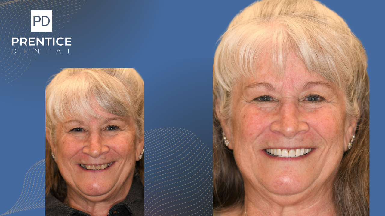 Full-mouth transformation restoration before after Prentice Dental Texas