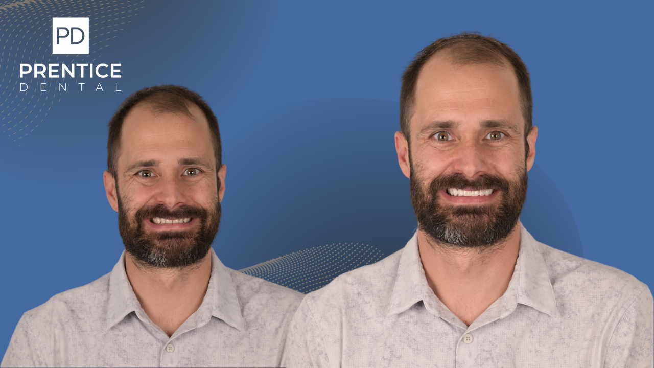 Cosmetic smile redesign before and after digital smile design Prentice Dental