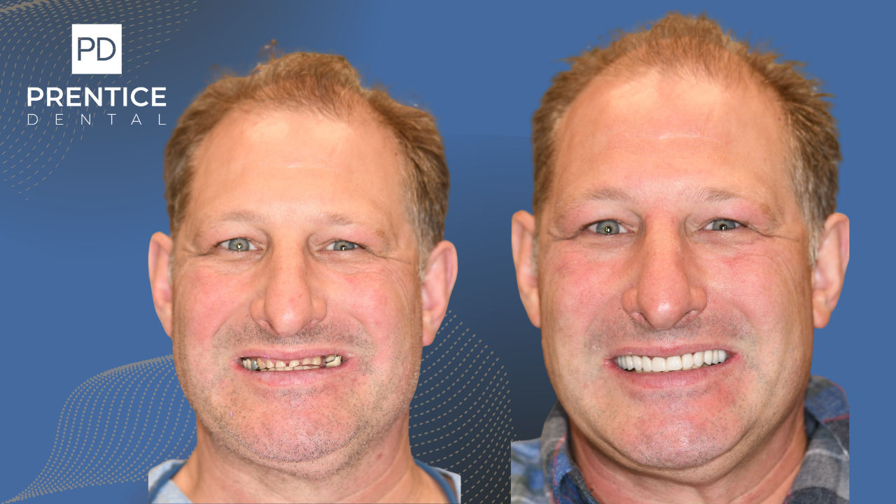 Total smile makeover full-mouth veneers before after Prentice Dental Flower Mound