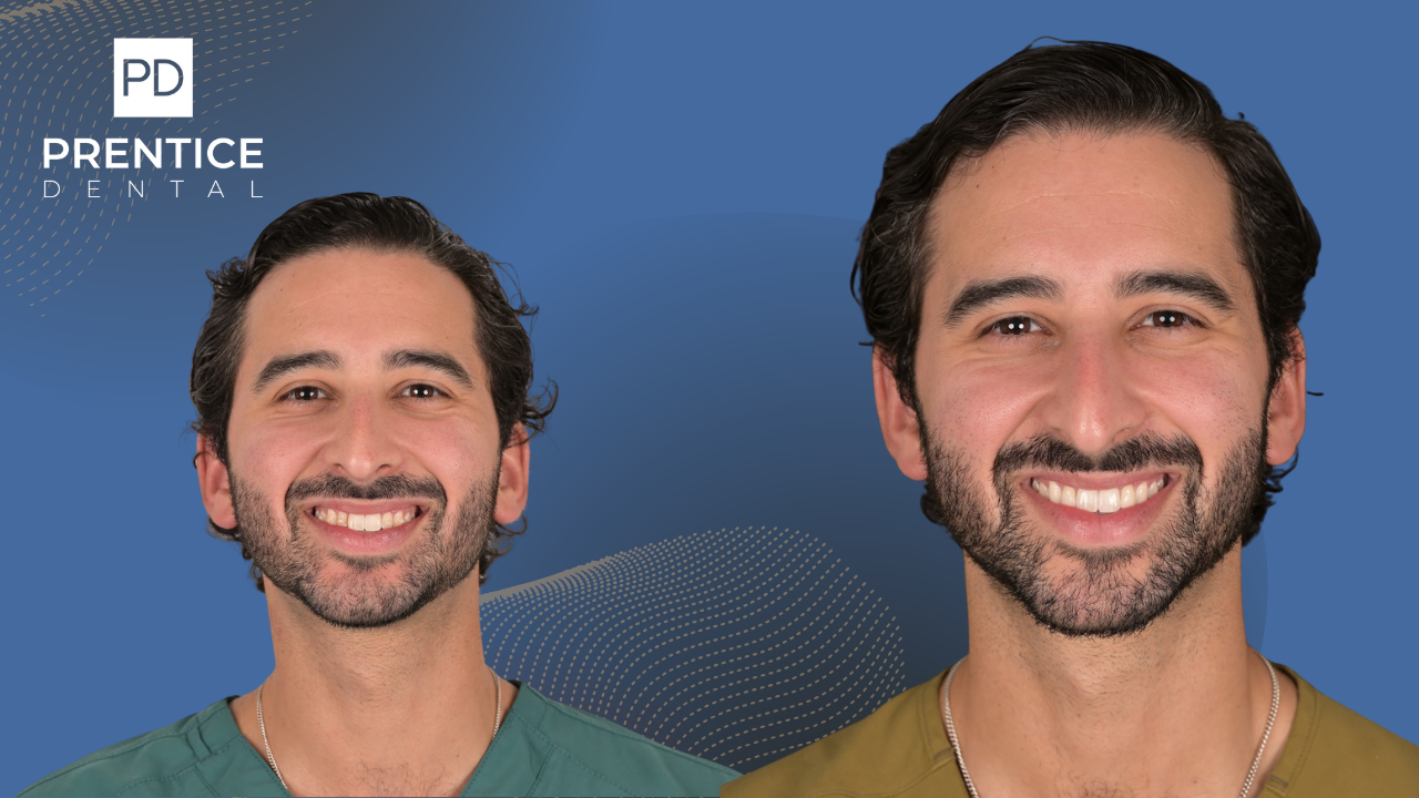 Minimal prep veneers before and after male patient Prentice Dental Flower Mound