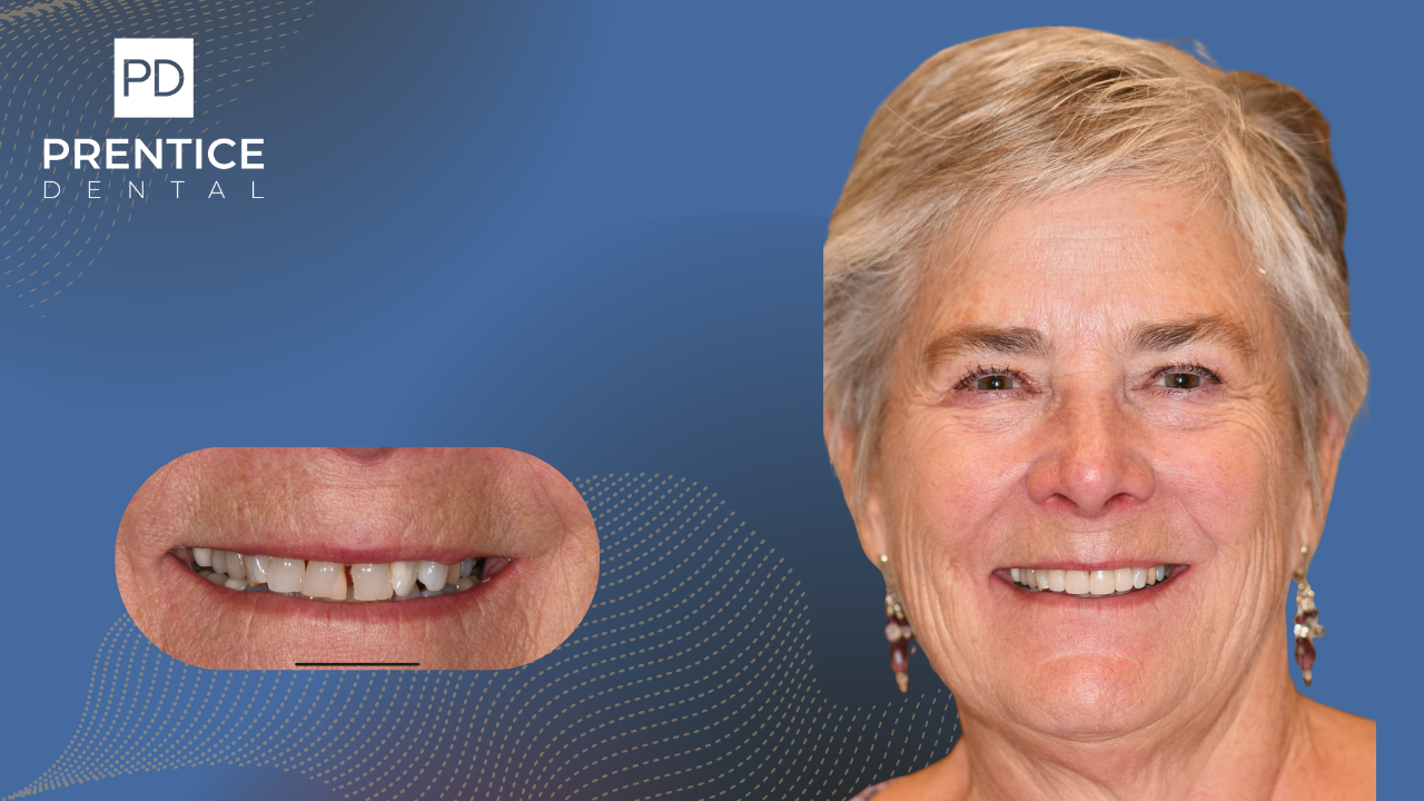 Porcelain veneers smile makeover before and after female patient Flower Mound