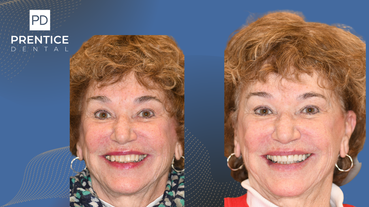 Full smile enhancement with veneers before and after male patient Prentice Dental