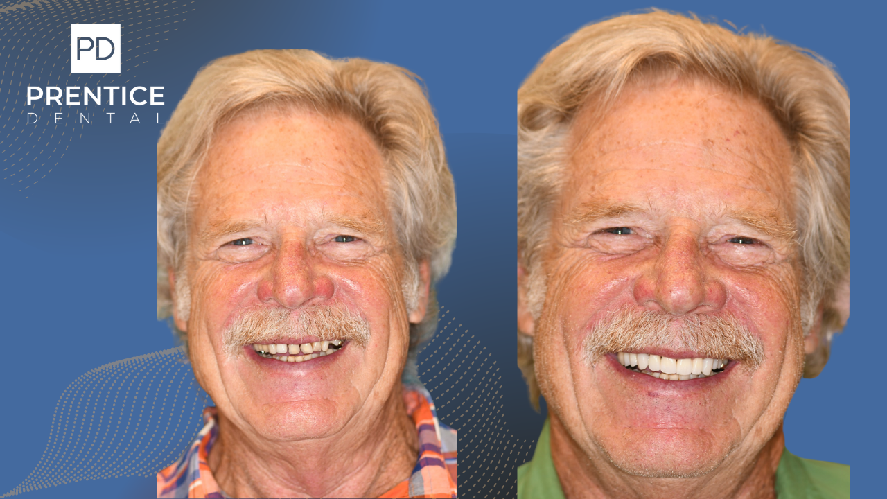 Extensive smile reconstruction senior male before after Flower Mound dental