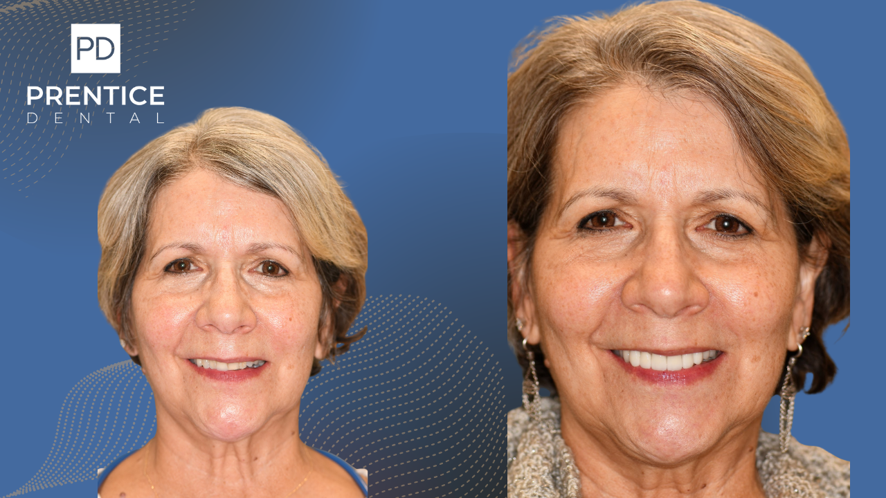 Youthful smile enhancement cosmetic dentistry before after young male Flower Mound
