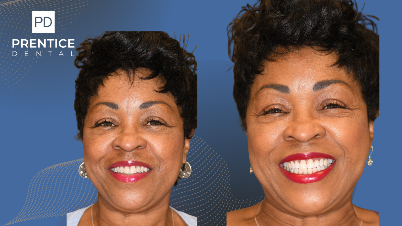 Before and after professional teeth whitening and cosmetic bonding results Flower Mound TX