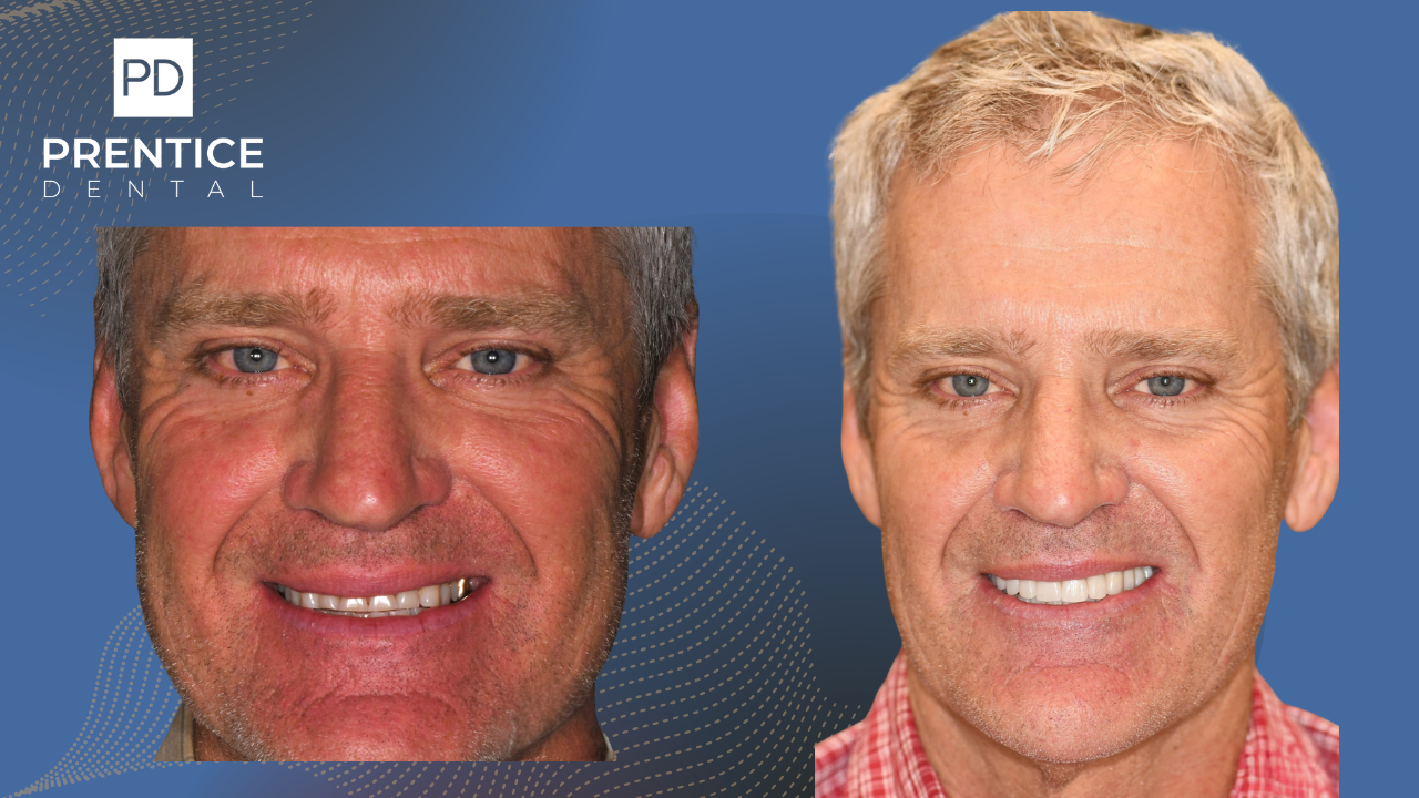 Patient after full-mouth reconstruction with same-day crowns