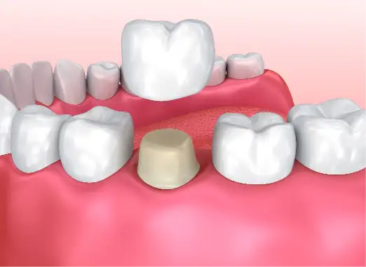 SAME-DAY CROWNS